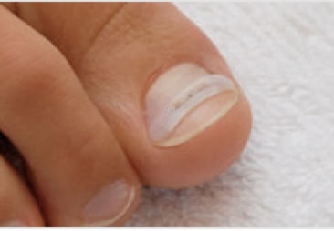 afbeelding nagelbeugel op de teen.